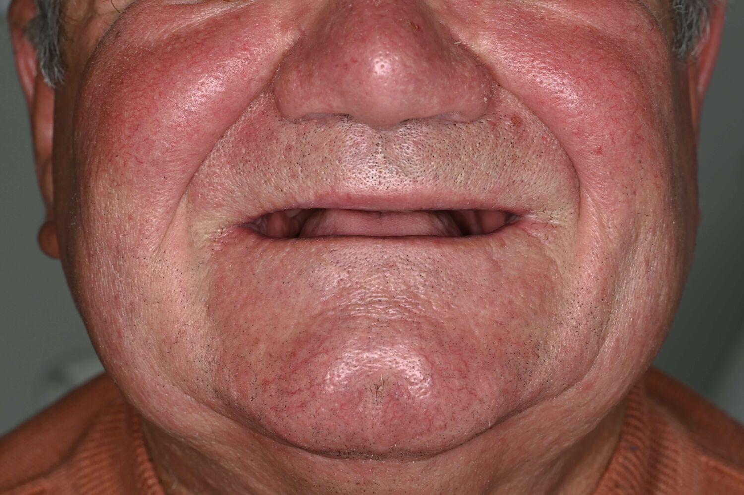 Pacient Clinica Dr. Alin Odor - Rezultat Implantologie